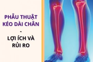 Lợi ích và nguy hại khó lường của phẫu thuật kéo dài chân