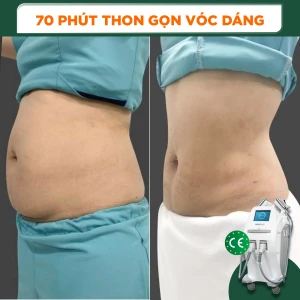 Điêu Khắc Body Cooltech Define Kết Hợp RF Vùng Bụng Trên