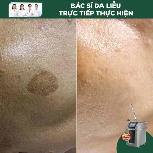 Điều Trị Bớt Sắc Tố Bằng Laser Pico Pro (< 5cm2)