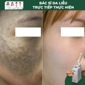 Điều Trị Bớt Sắc Tố Với Laser RevLite