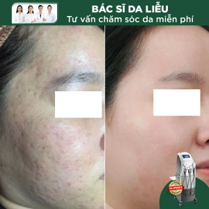Điều Trị Hồng Ban Sau Mụn, Giãn Mao Mạch Bằng IPL