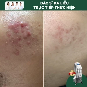 Điều Trị Mụn Bằng IPL (Cơ Bản)