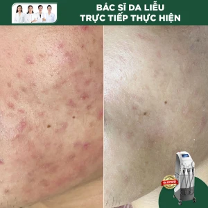 Điều Trị Mụn Bằng IPL (F-AC)