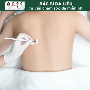 Điều Trị Mụn, Giảm Thâm Bằng BHA 20% Vùng Nửa Lưng