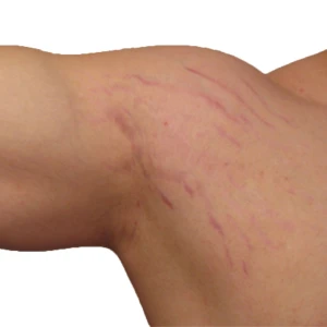 Điều Trị Rạn Da Vùng Bắp Tay (1 Bên)