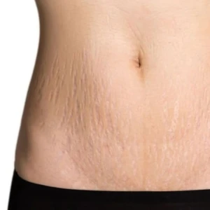 Điều Trị Rạn Da Vùng Bụng