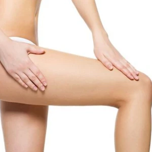 Điều Trị Rạn Da Vùng Đùi (1 Bên)