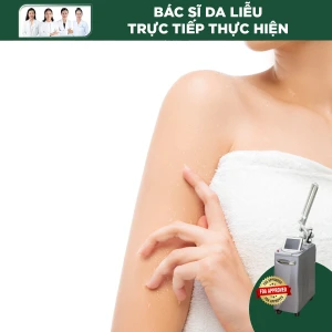Điều Trị Sắc Tố Vùng Nửa Tay Bằng Laser Revlite