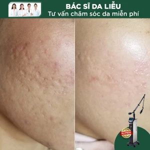 Điều Trị Sẹo Lõm Phương Pháp 5in1