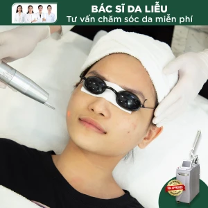 Điều Trị Tàn Nhang Bằng Laser Revlite (1 nốt)