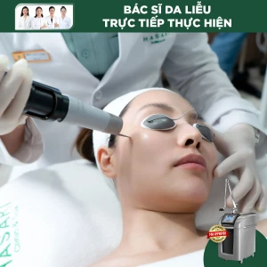 Điều Trị Tàn Nhang Gò Má Bằng Laser Pico Pro