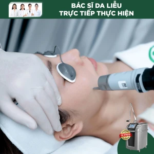 Điều Trị Tàn Nhang Toàn Má Bằng Laser Pico Pro