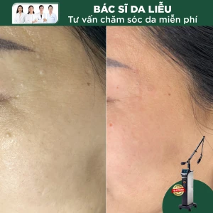 Đốt Hạt Kê (Milia) Bằng Laser CO2 (1 Nốt)