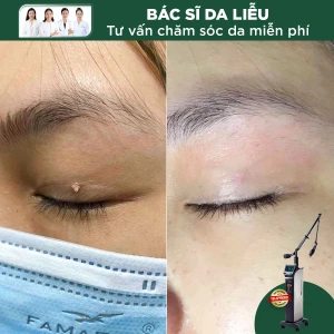 Đốt Mụn Cóc Bằng Laser CO2 (1 Nốt)