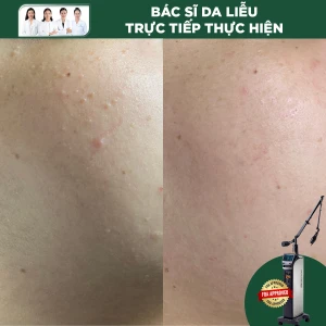 Đốt Mụn Cóc Phẳng Bằng Laser CO2 (1 Nốt)