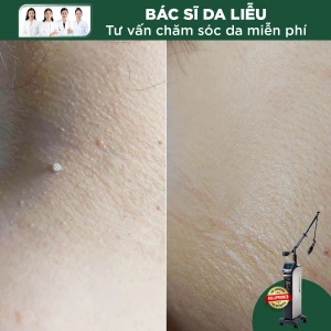 Đốt Skintag (Đuôi Da) Bằng Laser CO2 (1 Nốt)