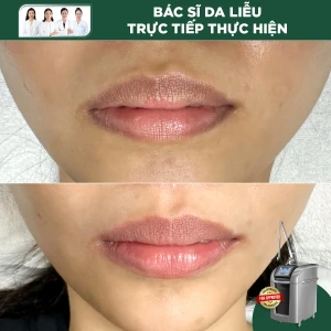 Làm Hồng Môi Bằng Laser Pico Pro