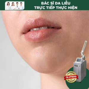 Làm hồng môi bằng Laser Revlite