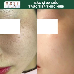 Lăn Kim Điều Trị Nám Với Tranexamic Acid