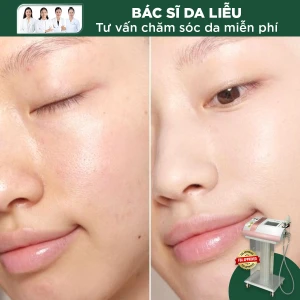 Mesoderm Dưỡng Sáng Vitamin C-20% Vùng Mặt (Tây Ban Nha)