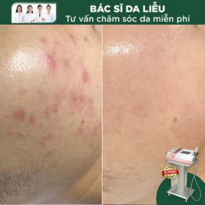 Mesoderm Trị Mụn