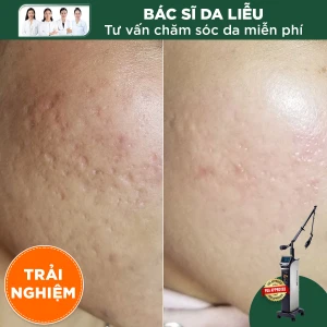 Trải Nghiệm Điều Trị Sẹo Lõm Phương Pháp 5in1