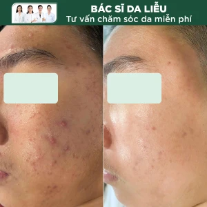 Trị Mụn - Kiểm Soát Dầu Accu Toning Laser