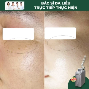 Trị Tàn Nhang Gò Má Công Nghệ Laser RevLite