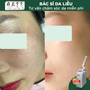 Trị Tàn Nhang Toàn Má Công Nghệ Laser RevLite
