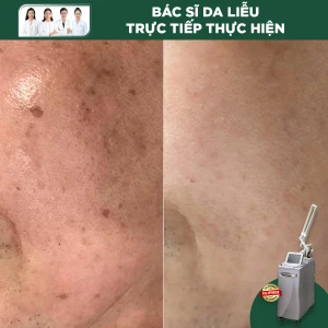 Trị Tàn Nhang Toàn Mặt Công Nghệ Laser RevLite