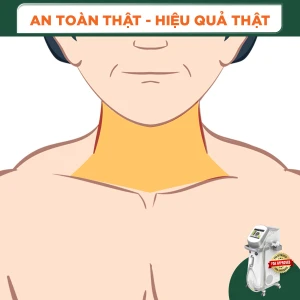 Triệt Lông Cổ Nam Diode Laser (10 Buổi) (Bảo Hành 5 Năm)