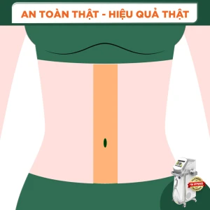 Triệt Lông Đường Thẳng Bụng ( 1 Buổi )