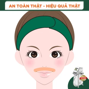 Triệt Lông Mép (1 Buổi )