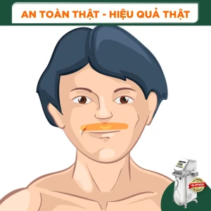 Triệt Lông Mép Nam Diode Laser (10 Buổi) (Bảo Hành 5 Năm)