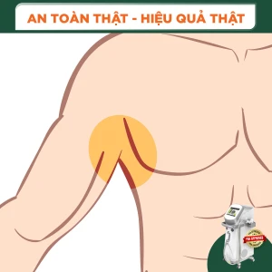 Triệt Lông Nách (1 Buổi )