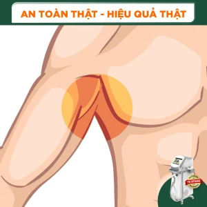 Triệt Lông Nách Nam Diode Laser (10 Buổi) (Bảo Hành 5 Năm)