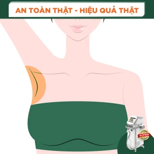 Triệt Lông Nách Nữ Diode Laser (8 Buổi) (Bảo Hành 5 Năm)