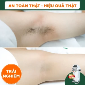 Triệt Lông Nách Nữ Diode Laser (Trải Nghiệm) 