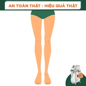 Triệt Lông Nguyên Chân Nữ Diode Laser (8 Buổi) (Bảo Hành 5 Năm)
