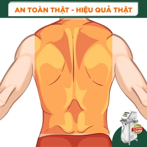 Triệt Lông Nguyên Lưng Nam Diode Laser (10 Buổi) (Bảo Hành 5 Năm)