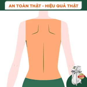 Triệt Lông Nguyên Lưng Nữ Diode Laser (8 Buổi) (Bảo Hành 5 Năm)