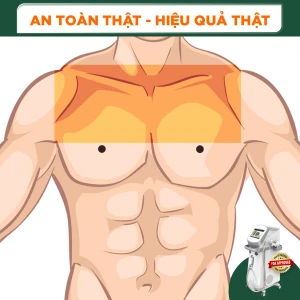 Triệt Lông Nửa Ngực Nam Diode Laser (10 Buổi) (Bảo Hành 5 Năm)