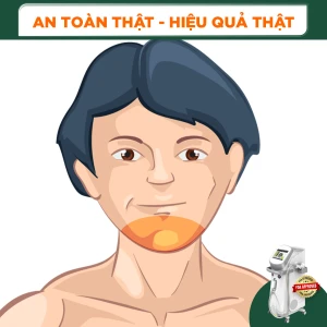 Triệt Lông Râu Cằm Nam Diode Laser (10 Buổi) (Bảo Hành 5 Năm)