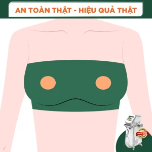 Triệt Lông Ti Nữ (1 buổi)