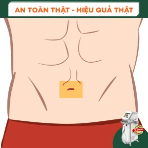 Triệt Lông Viền Rốn Nam (1 Buổi )