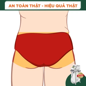 Triệt Lông Vùng Mông Nam Diode Laser (10 Buổi) (Bảo Hành 5 Năm)