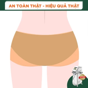 Triệt Lông Vùng Mông Nữ Diode Laser (8 Buổi) (Bảo Hành 5 Năm)