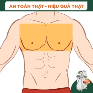 Triệt Lông Vùng Ngực Nam Diode Laser (10 Buổi) (Bảo Hành 5 Năm)