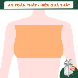 Triệt Lông Vùng Ngực Nữ Diode Laser (8 Buổi) (Bảo Hành 5 Năm)