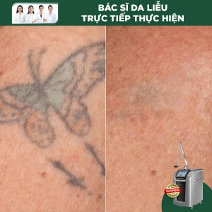 Xóa Xăm Bằng Laser Pico Pro (< 5 cm2) 